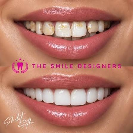 Smile Makeover In Amritsar